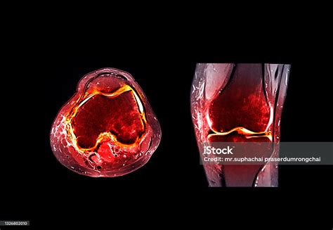 Magnetic Resonance Imaging Or Mri Knee Joint Comparison Coronal And