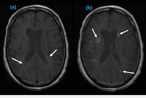 Axial T1 Mri Images Showing Periventricular Lesions Of Various