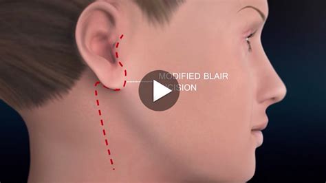 Parotid Surgery Animation Overview Of Minimally Invasive