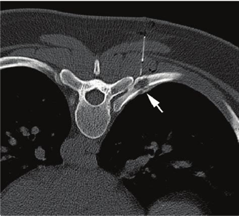 Ct Guided Hookwire Localization And Injection Of Blue Dye Prior