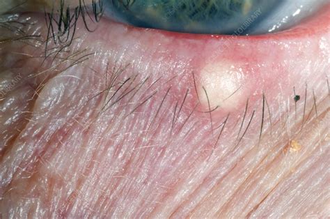 Chalazion Cyst On The Lower Eyelid Stock Image C0069188 Science