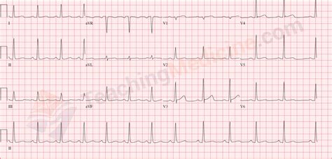 12 Lead Ekg Sinus Rhythm