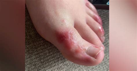Covid Toes Mysterious Rash Can Affect Feet In Patients With
