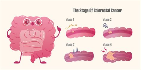 Colon Cancer Treatment Options For Stage 4 Colon Cancer