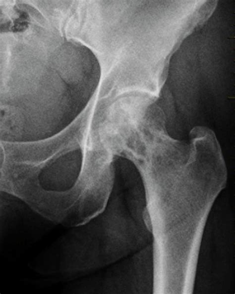 Secondary Bone Cancer In The Hip Photograph By Zephyrscience Photo