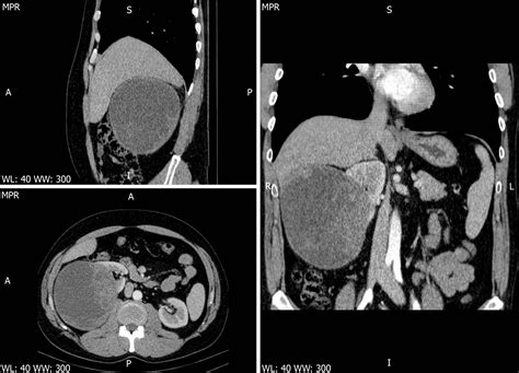 Cystic Low Grade Collecting Duct Renal Carcinoma With Liver Compression