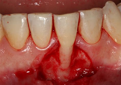 Management Of Mandibular Anterior Teeth With Gingival Recession 182