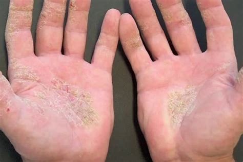 Taking Control Of Hand Eczema