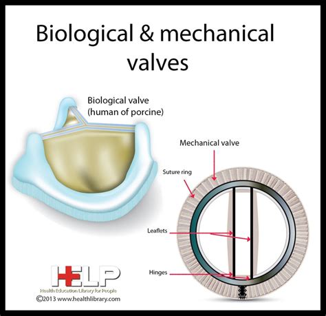 Biological And Mechanical Valves Heart Valves Aortic Valve Replacement