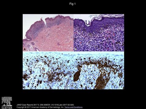 Recurrent Halo Nevus Dermoscopy And Confocal Microscopy Features Ppt