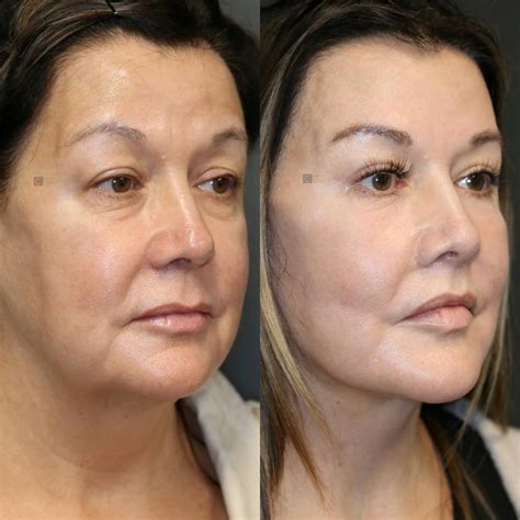 Patient 123023726 Enigmalift Mid Face Lift Before And After Clinic 5c