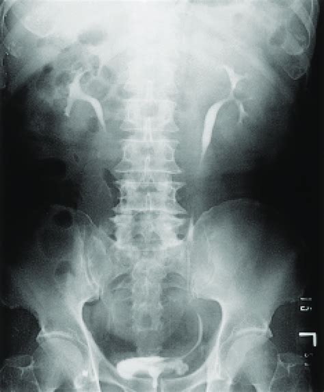 Anterior Posterior Intravenous Urography Film 15 Minutes After