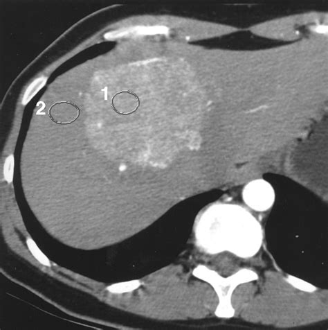 Multiphase Hepatic Ct With A Multirow Detector Ct Scanner Ajr