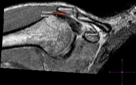 A Coronal Image Of Subjects Shoulder In The Horizontal Impingement