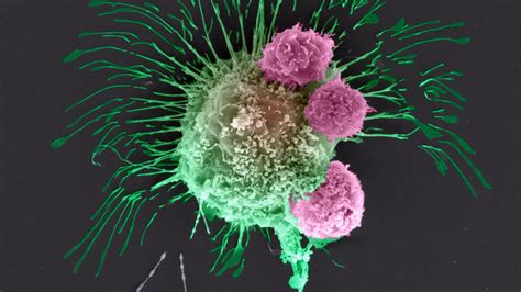 Breast Cancer Cells Under Microscope