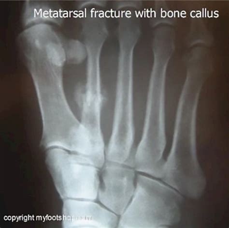 Stress Fractures Of The Foot Causes And Treatment Options