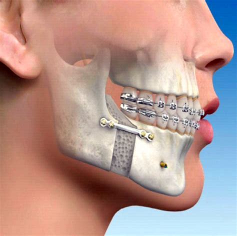 Jaw Surgery Osteotomy Pacific Oral Surgery