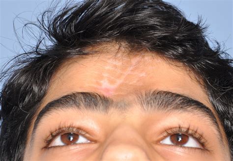 Plastic Surgery Case Study Hydroxyapatite Cement Forehead