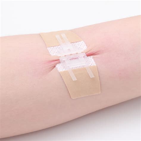 Wound Closure Device Longmed Medical Technology Company