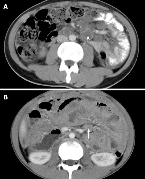 Tuberculosis Versus Non Hodgkins Lymphomas Involving Small Bowel