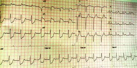 Ecg Showing St Segment Elevation In Leads I Avl Avr V4 Through V6