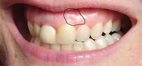 White Patch On Gum By Tooth Buddymaster