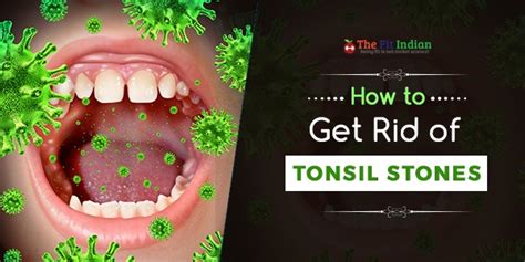 10 Natural Home Remedies To Get Rid Of Tonsil Stones Prevent Tonsils