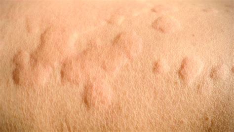 Whats On My Skin 8 Common Bumps Lumps And Growths Skin Health