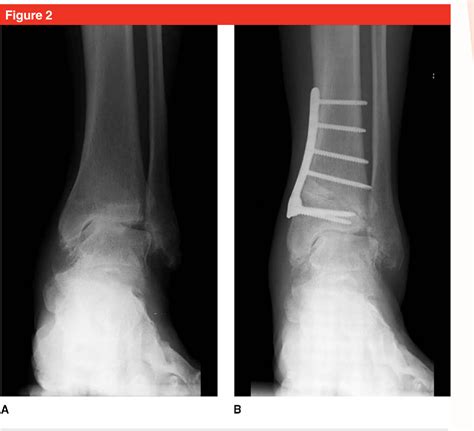 Figure 1 From Supramalleolar Osteotomies For The Treatment Of Ankle