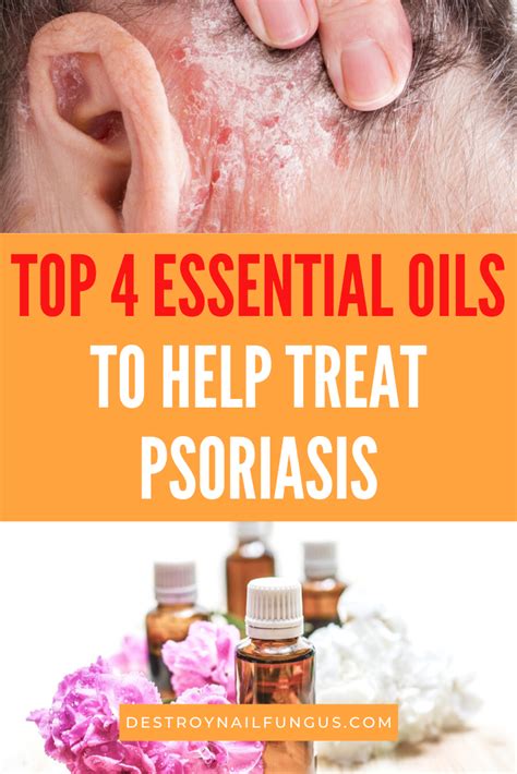 The Best Psoriasis Remedies Essential Oils For Fast Relief