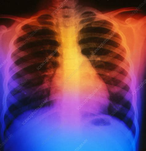 False Colour Chest X Ray Normal 7 Year Old Child Stock Image P590