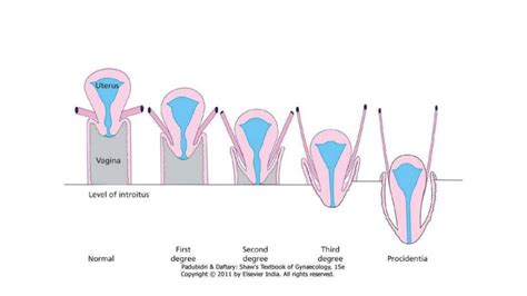 Pelvic Organ Prolapse Gynaecology Ppt