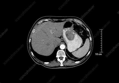 Stomach Cancer Ct Scan Stock Image C0261107 Science Photo Library