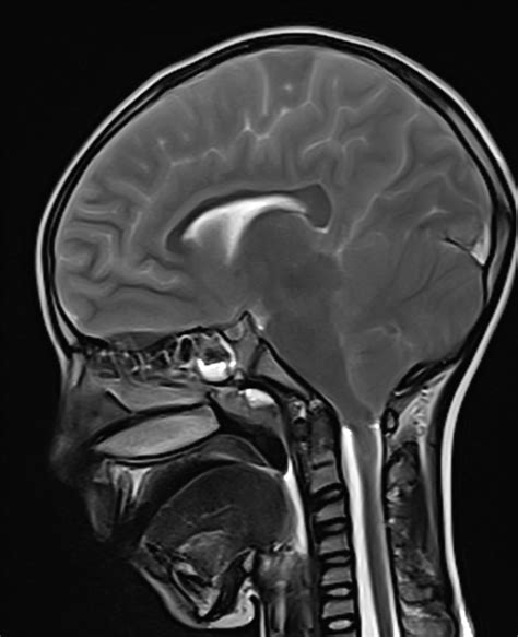 Brain Herniation Pacs