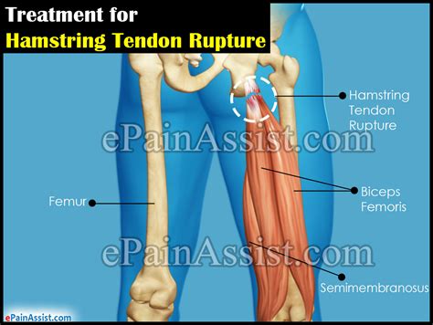 Treatment For Hamstring Tendon Rupturesurgicalnon Surgical