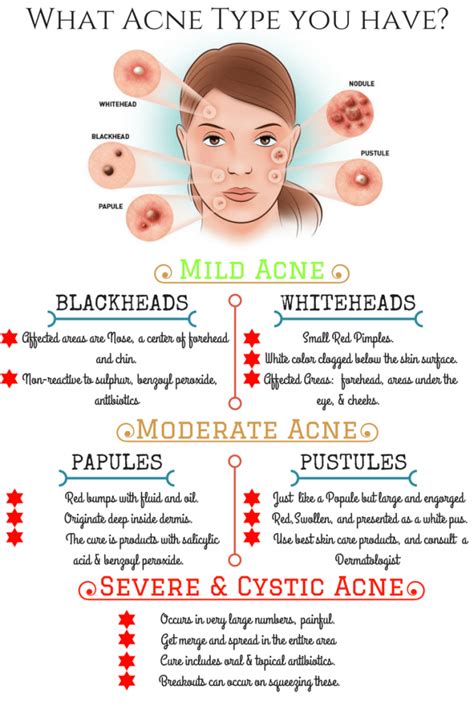 Acnevulgaris Acnetypes Read About Various Types Of Acne Vulgaris And