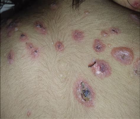 Target And Targetoid Lesions In Dermatology Indian Journal Of