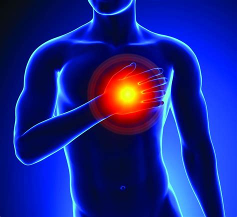 Myocardial Infarction Photo