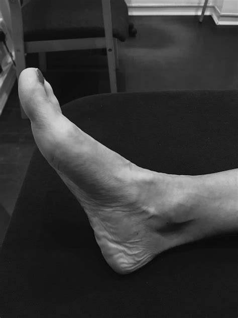 Sprained Ankle Explained Edinburgh Physiotherapist