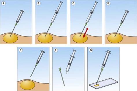 The Techniques Of Fna Cytology Basicmedical Key