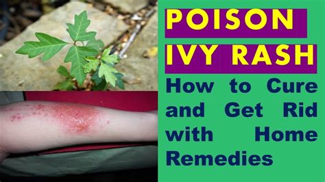 How To Cure And Get Rid Of Poison Ivy Rash Fast With Home Remedies