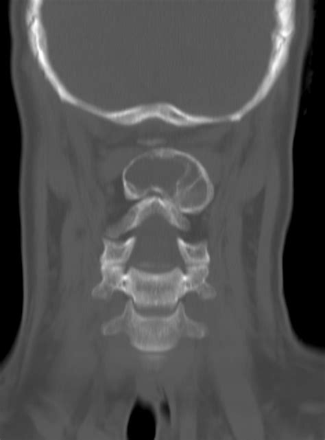 Aneurysmal Bone Cyst Cervical Spine Image