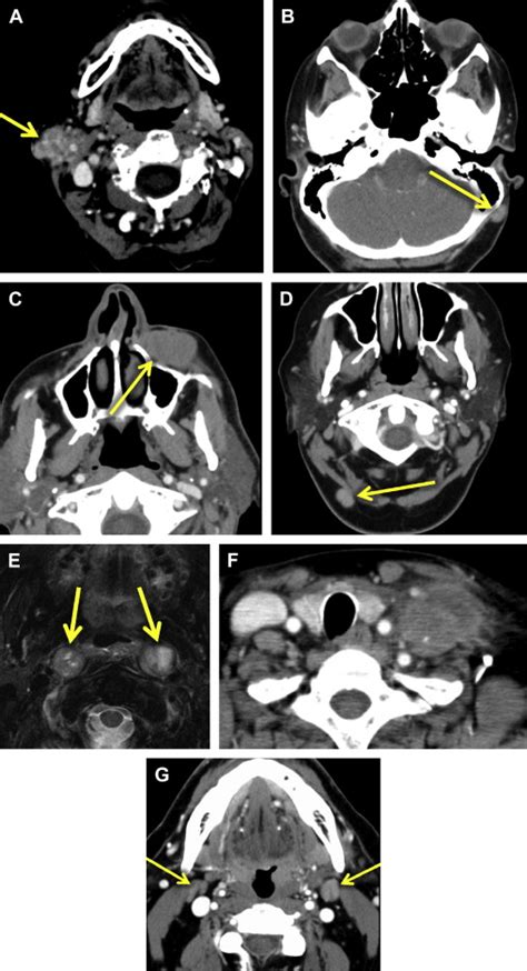 Imaging Of Head And Neck Lymph Nodes Radiologic Clinics