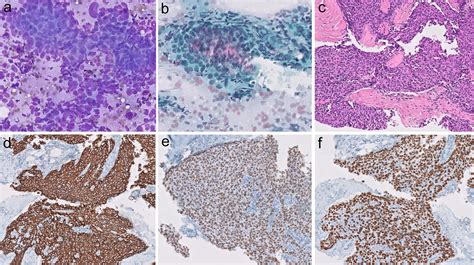 Fine Needle Aspiration Cytopathology Of Thymoma And Thymic Carcinoma A