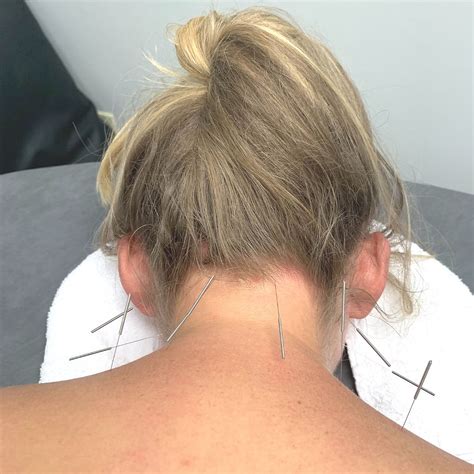 cupping vs dry needling which one is best for me