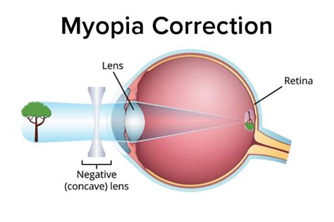 What Type Of Lens Is Used To Correct Nearsightedness