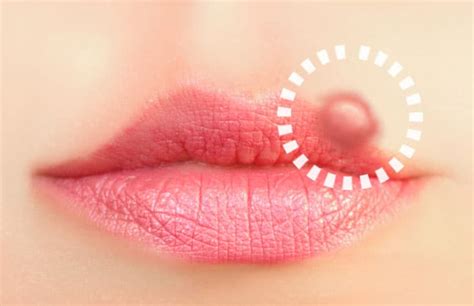 What causes them—and how to prevent them. Cold Sores and Canker Sores: How To Prevent Them With ...