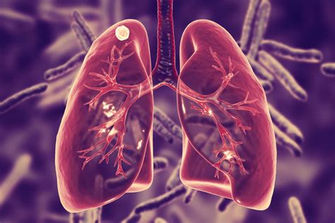 ¿qué Es La Tuberculosis Pulmonar Y Cuáles Son Sus Síntomas Mejor Con