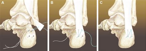 Schematic Of Achilles Tendon Insertion Repair With The Knotted Suture