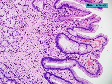 Qiaos Pathology Eosinophilic Gastritis Microscopic Photo Flickr